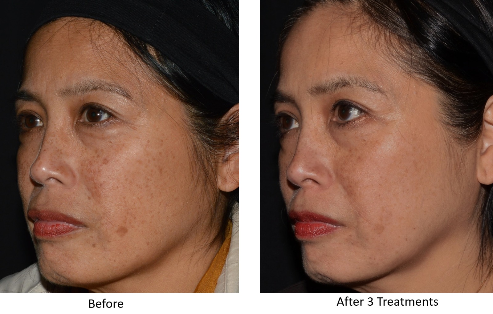 LaseMD Ultra Before and After - Fine Lines